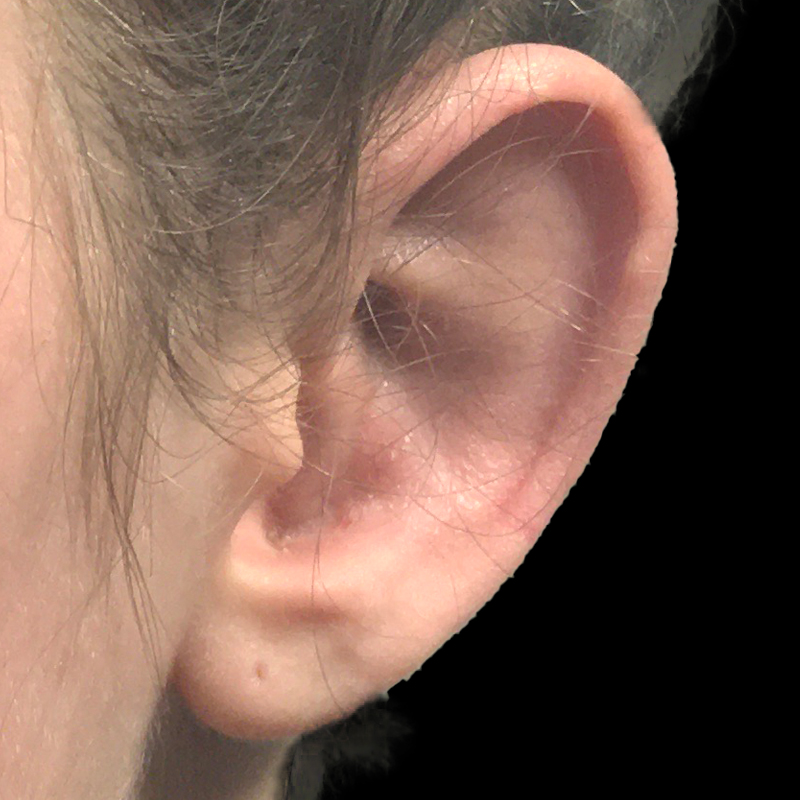 Extended Bilateral Otoplasty 05