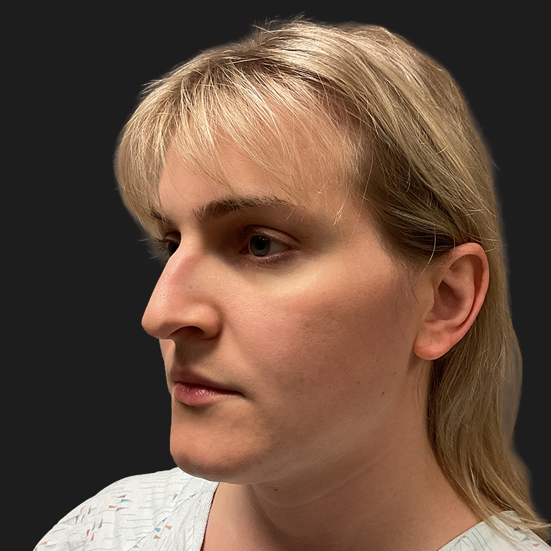 Facial Feminization 01