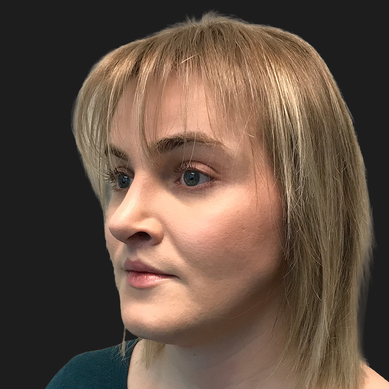 Facial Feminization 01