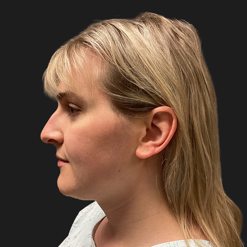 Facial Feminization 05