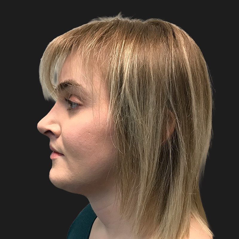 Facial Feminization 05