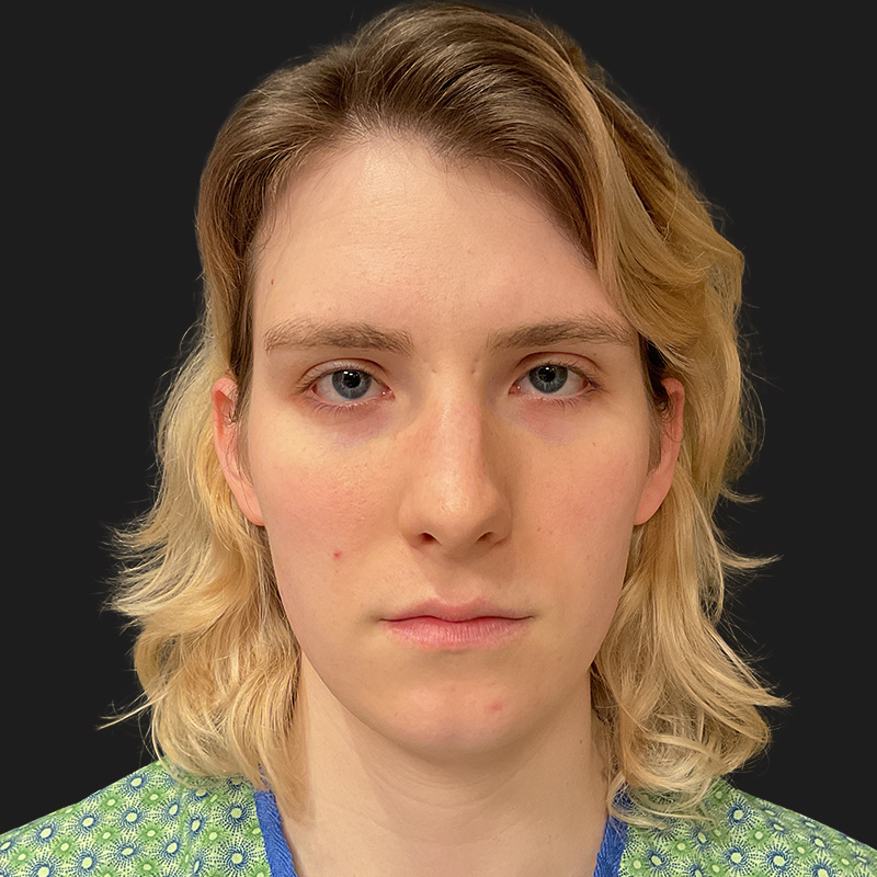 Facial Feminization 01