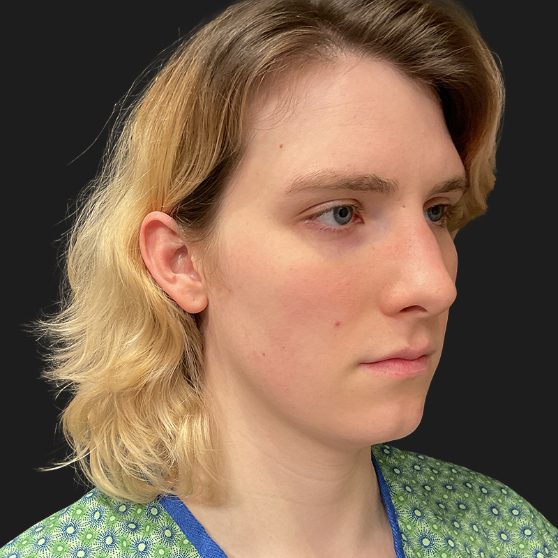 Facial Feminization 03