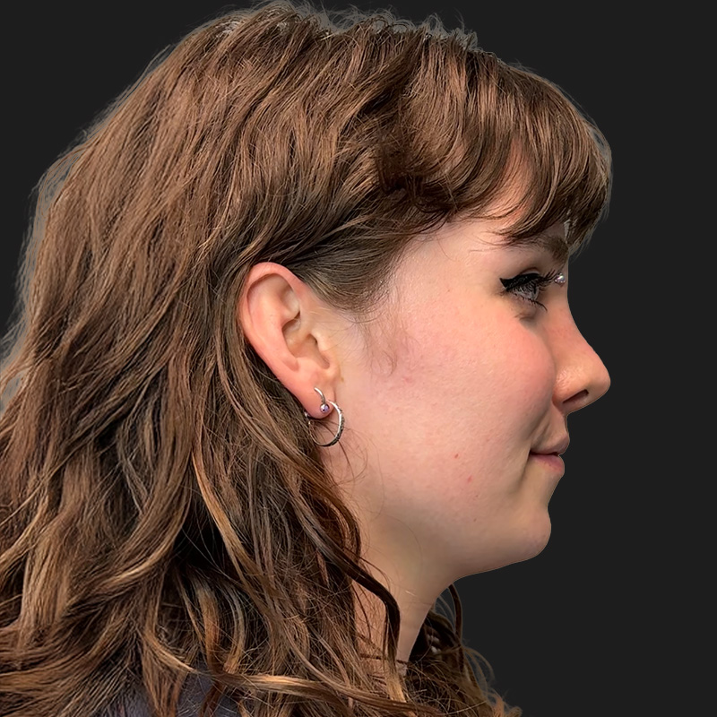 Facial Feminization 05