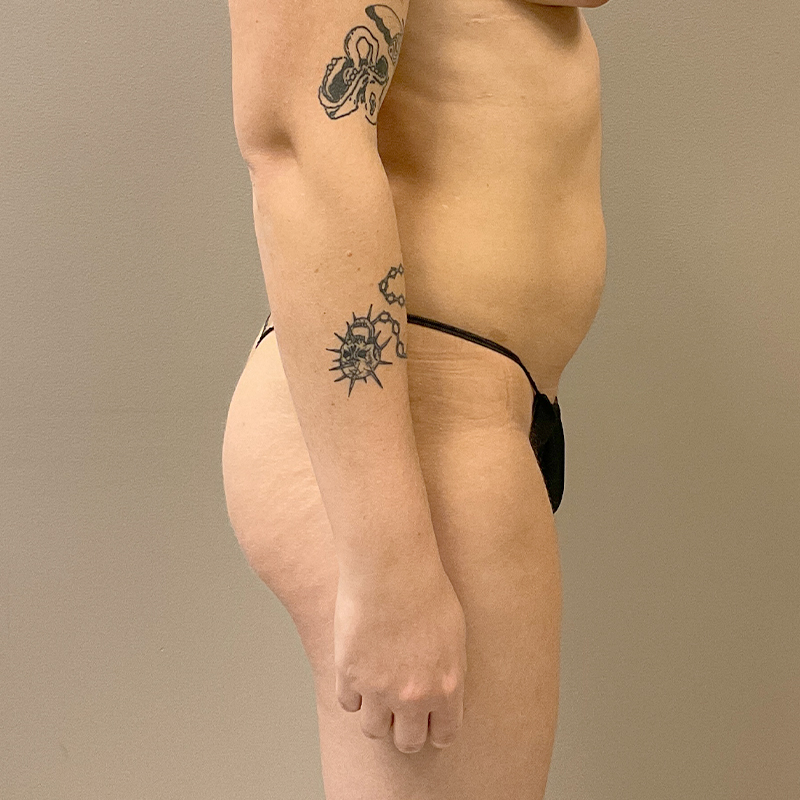 Brazilian Butt Lift 03