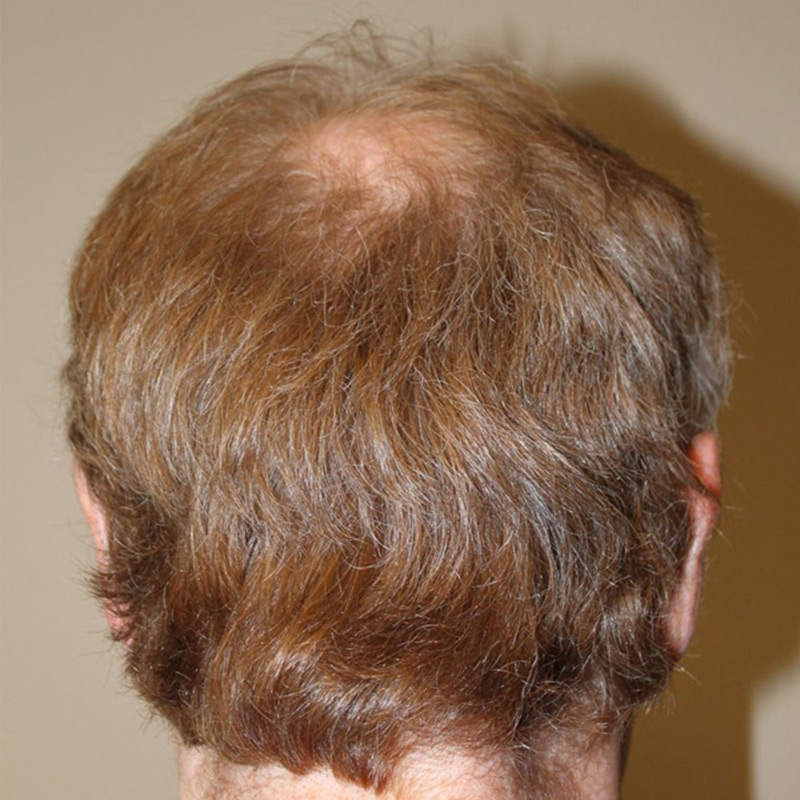 Hair Restoration Removed Photos Deletable 05