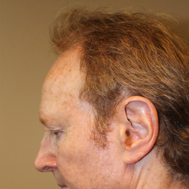 Hair Restoration Removed Photos Deletable 07