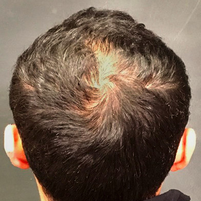 Hair Restoration Removed Photos Deletable 01