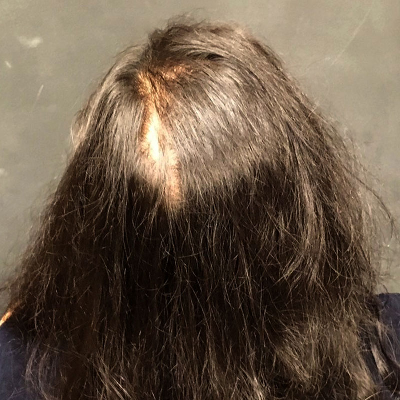 Hair Restoration Removed Photos Deletable 01