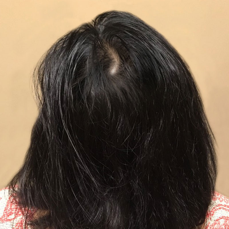 Hair Restoration Removed Photos Deletable 09