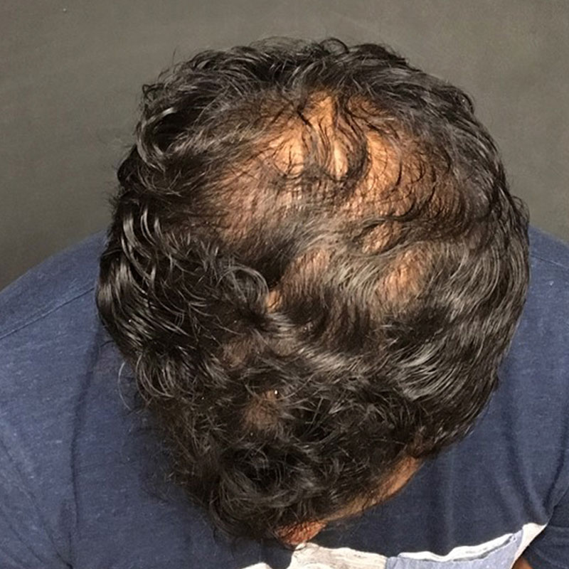 Hair Restoration Removed Photos Deletable 01