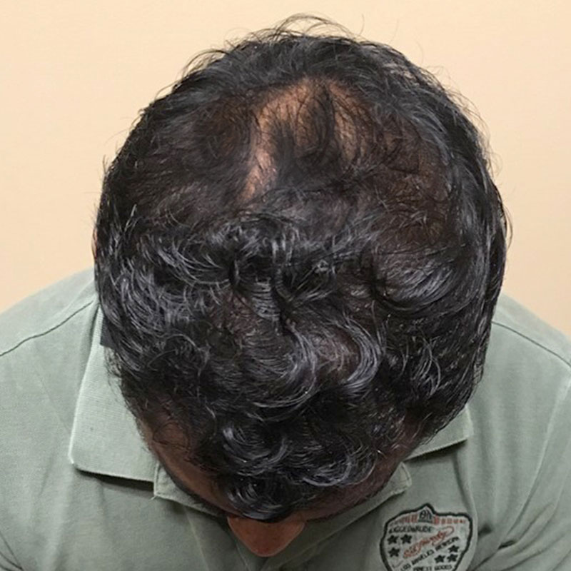 Hair Restoration Removed Photos Deletable 10