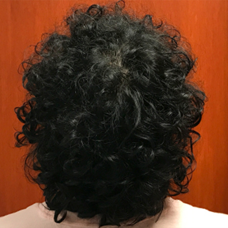 Hair Restoration Removed Photos Deletable 01