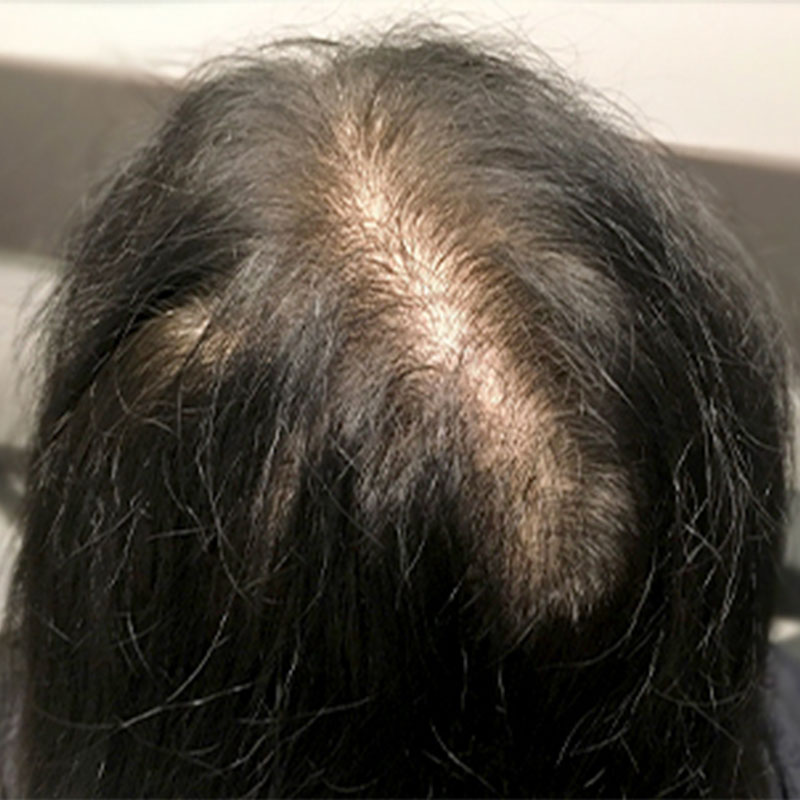 Hair Restoration Removed Photos Deletable 01