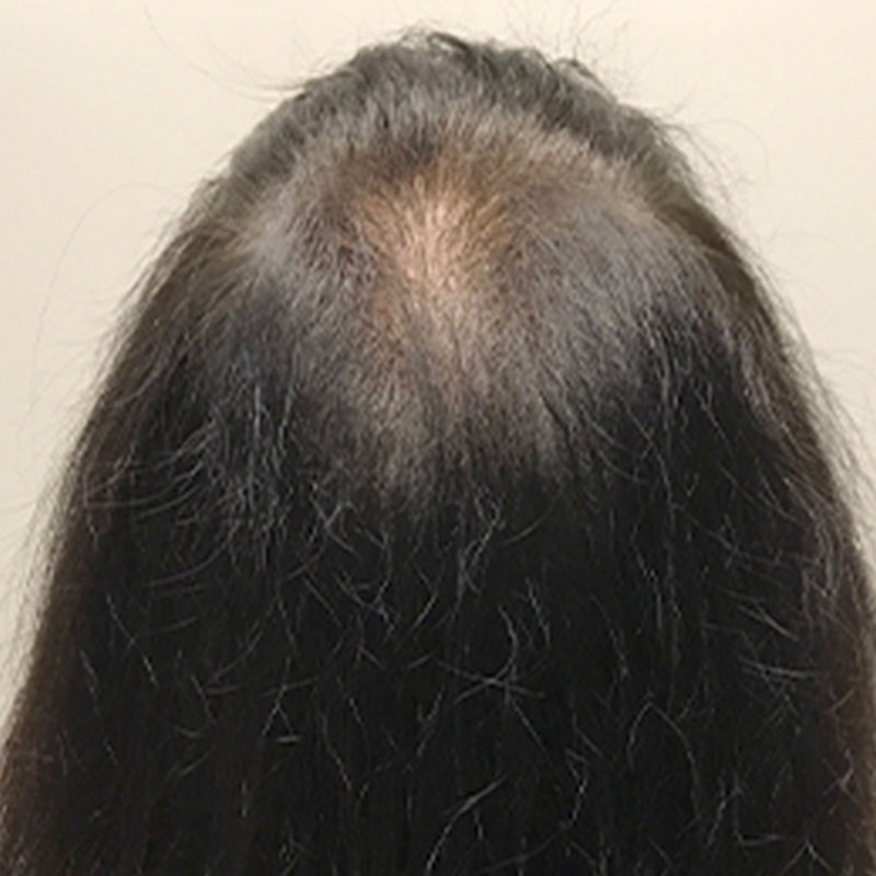 Hair Restoration Removed Photos Deletable 16