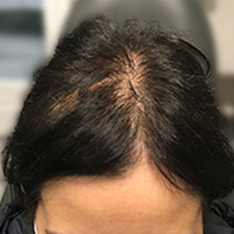 Hair Restoration Removed Photos Deletable 03