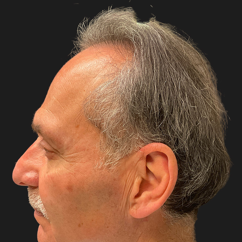Hair Transplant 05