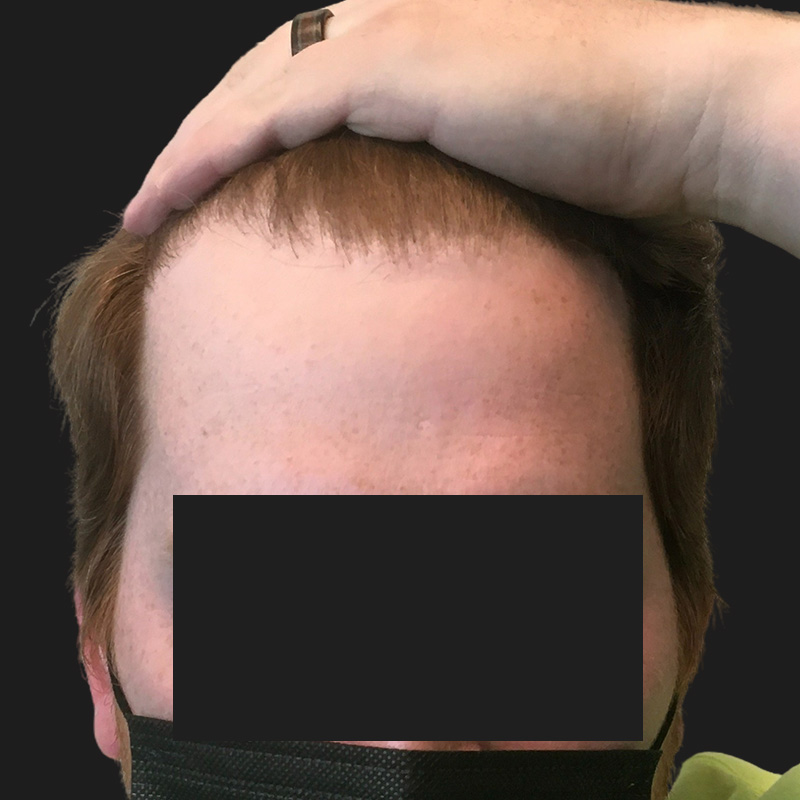 Hair Transplant 01
