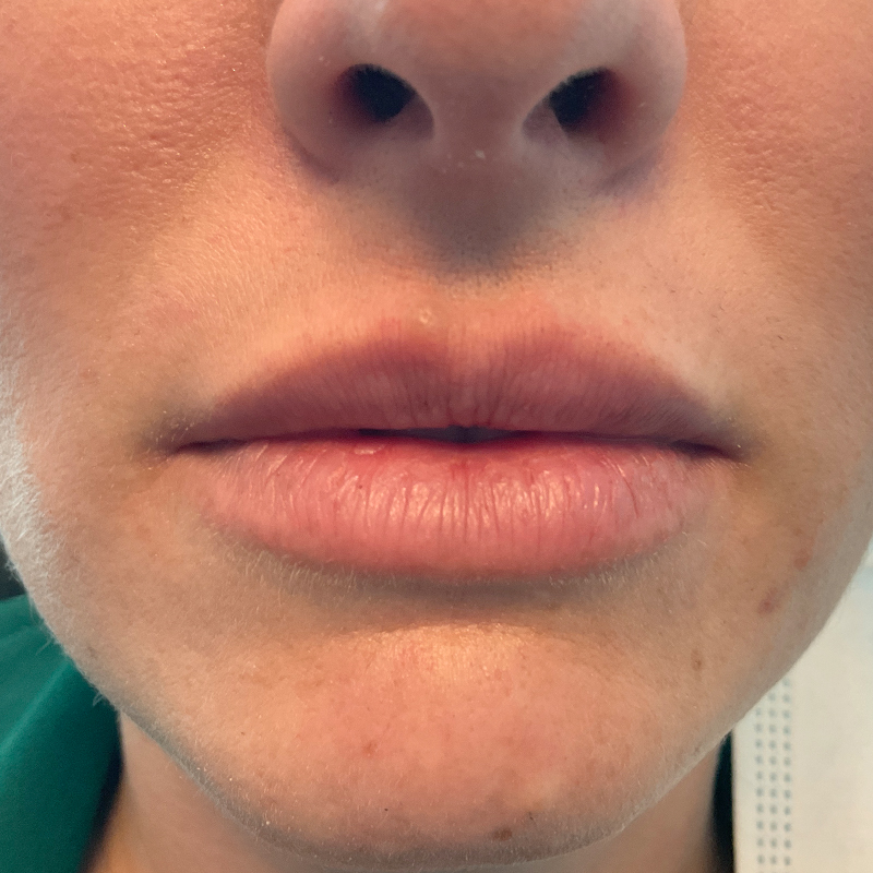 Lip Filler 01