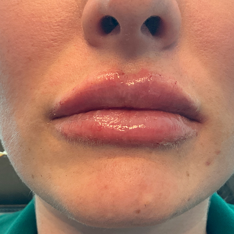 Lip Filler 01