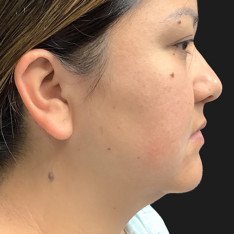 Lower Face Contouring 01