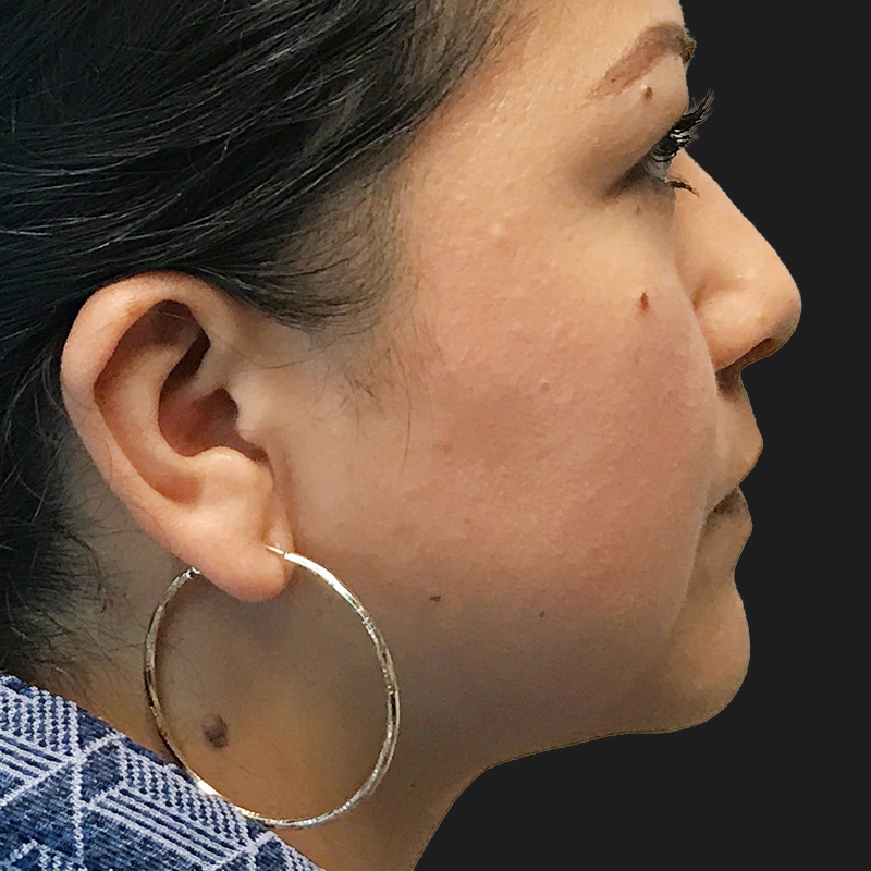 Lower Face Contouring 05
