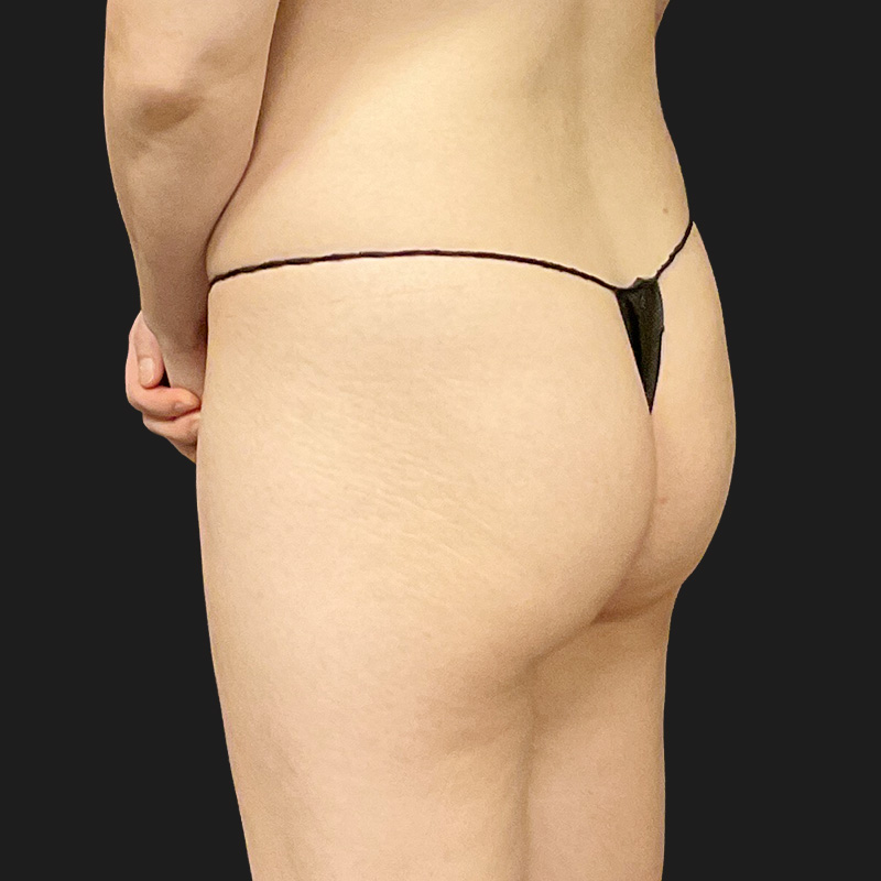 Mtf Brazilian Butt Lift 01