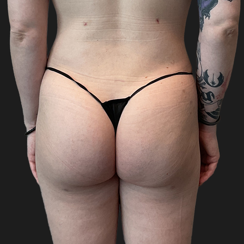 Mtf Brazilian Butt Lift 03