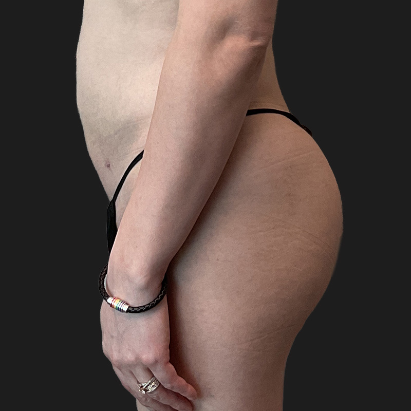 Mtf Brazilian Butt Lift 05