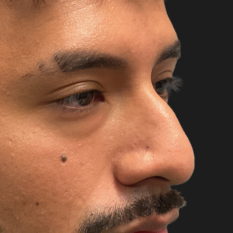 Non Surgical Rhinoplasty 01