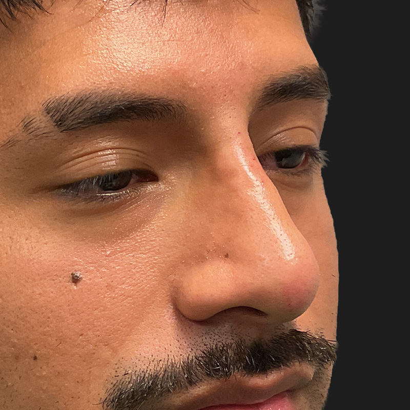 Non Surgical Rhinoplasty 29