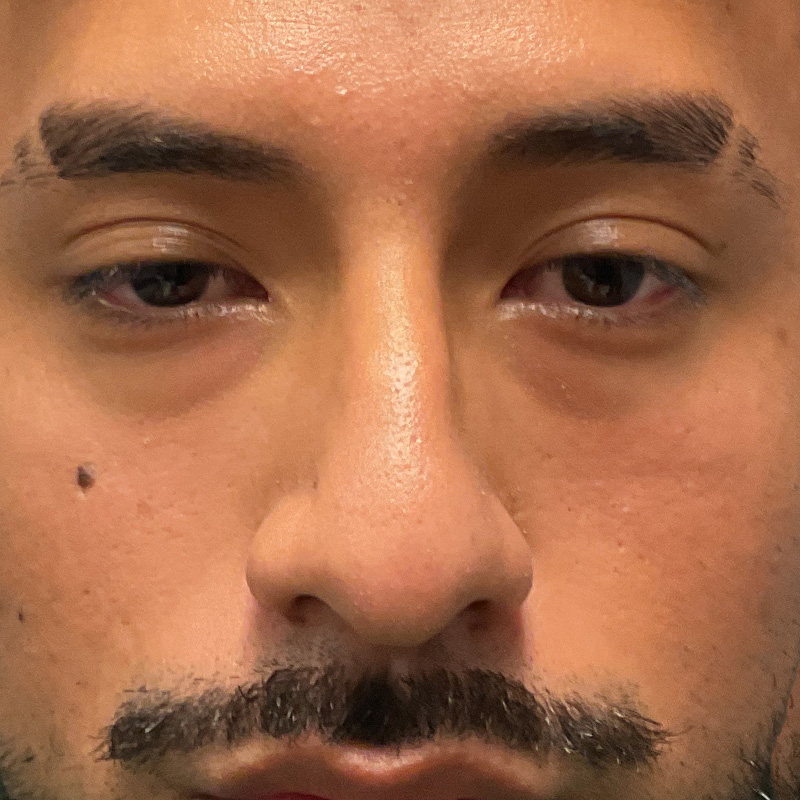 Non Surgical Rhinoplasty 03