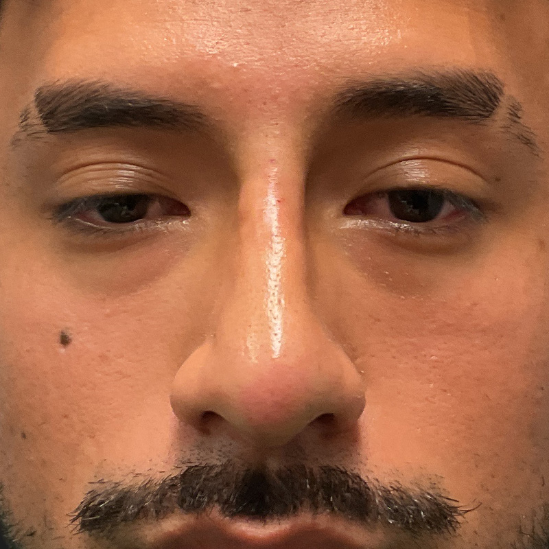 Non Surgical Rhinoplasty 04