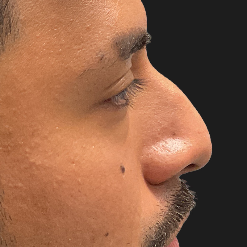 Non Surgical Rhinoplasty 05