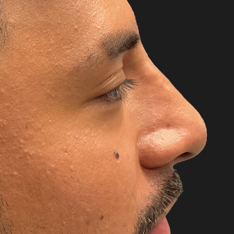 Non Surgical Rhinoplasty 06