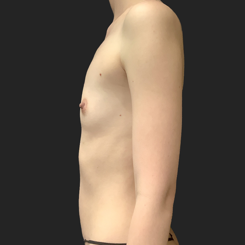 Transaxillary Breast Augmentation 03