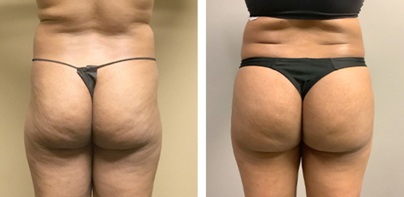 Mtf Body Contouring Before After 01