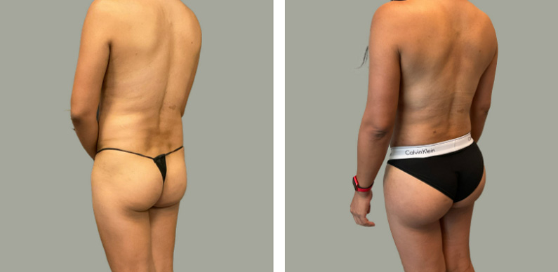 Mtf Body Contouring Before After 02