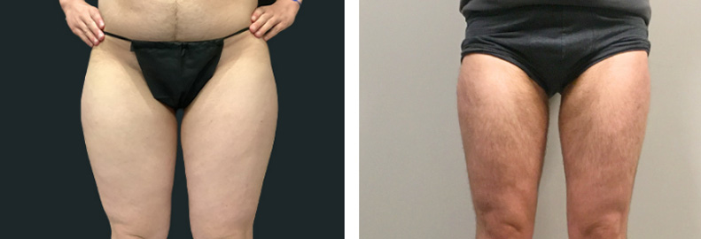 FTM Body Contouring Before After 02