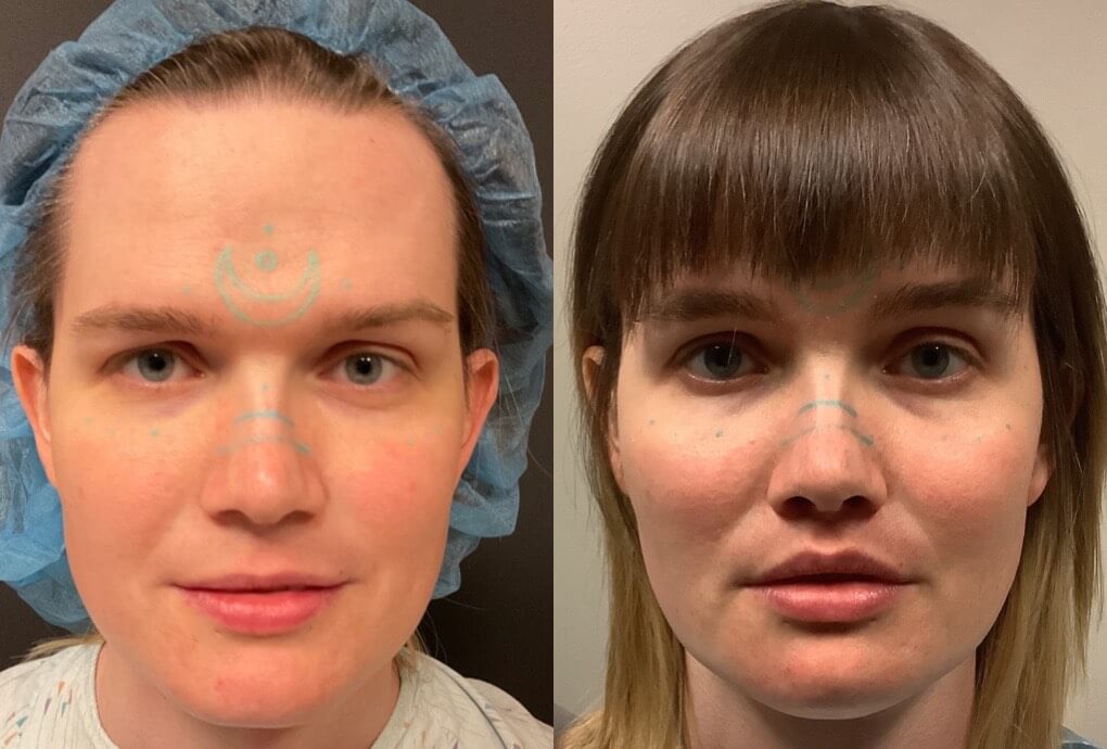 Facial Feminization Before & After