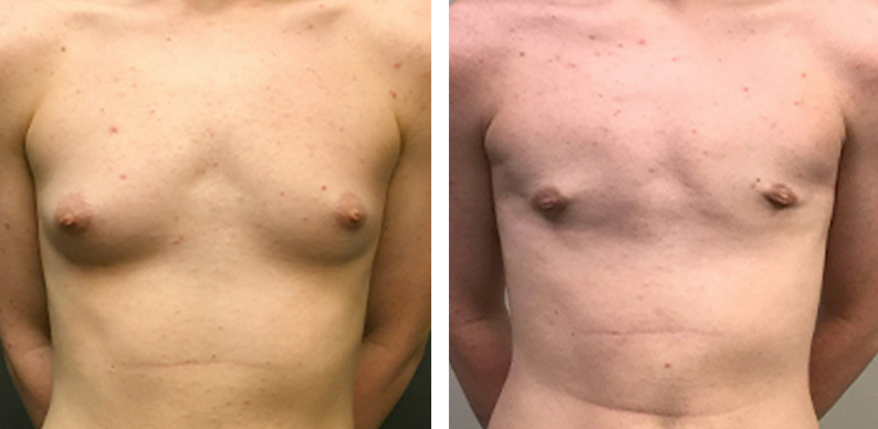 Keyhole Chest Reconstruction
